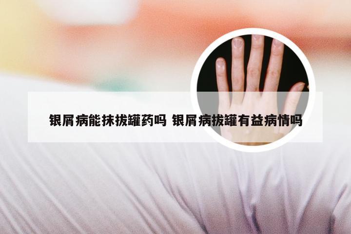 银屑病能抹拔罐药吗 银屑病拔罐有益病情吗