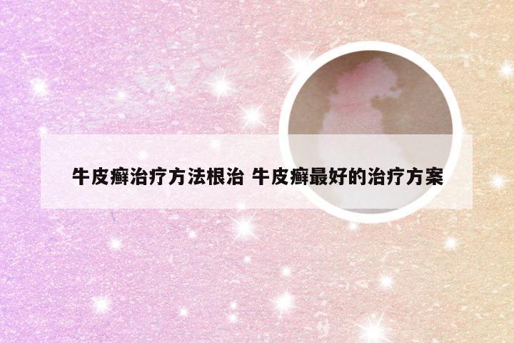 牛皮癣治疗方法根治 牛皮癣最好的治疗方案