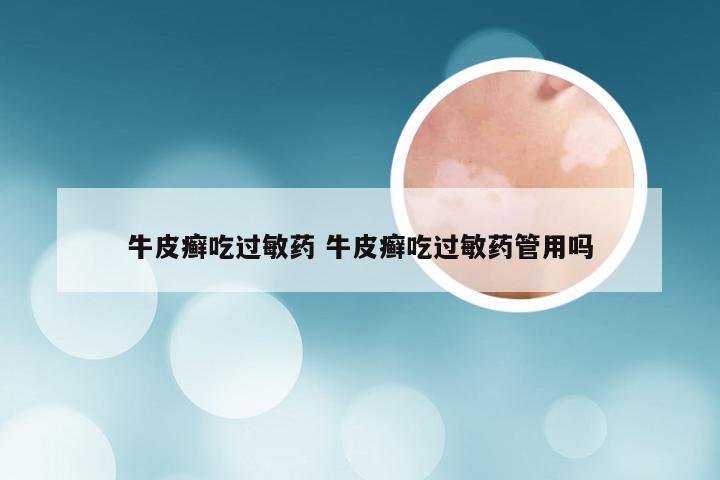 牛皮癣吃过敏药 牛皮癣吃过敏药管用吗