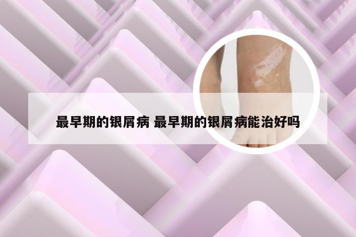 最早期的银屑病 最早期的银屑病能治好吗