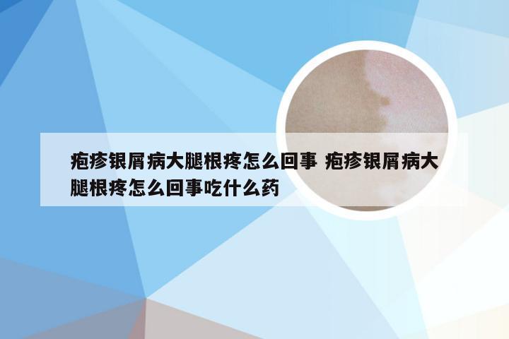 疱疹银屑病大腿根疼怎么回事 疱疹银屑病大腿根疼怎么回事吃什么药