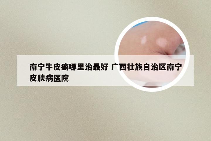 南宁牛皮癣哪里治最好 广西壮族自治区南宁皮肤病医院