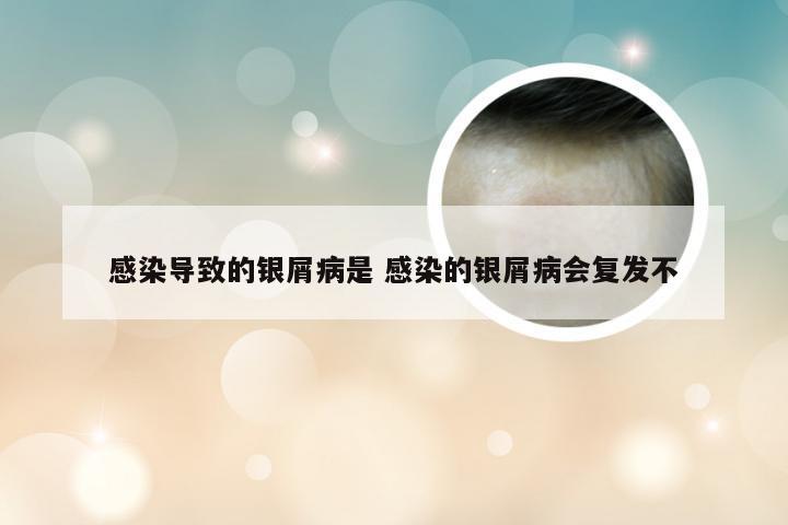 感染导致的银屑病是 感染的银屑病会复发不