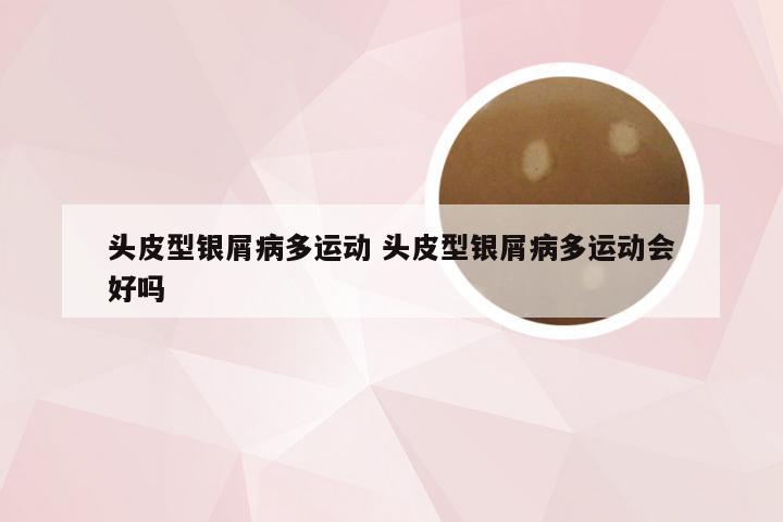 头皮型银屑病多运动 头皮型银屑病多运动会好吗