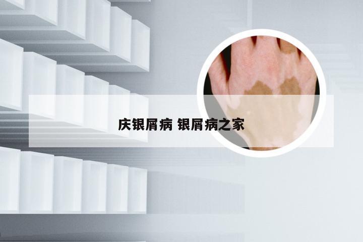 庆银屑病 银屑病之家