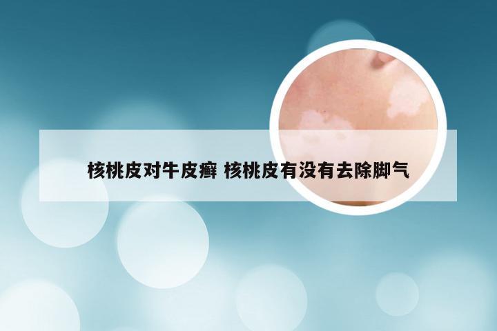 核桃皮对牛皮癣 核桃皮有没有去除脚气
