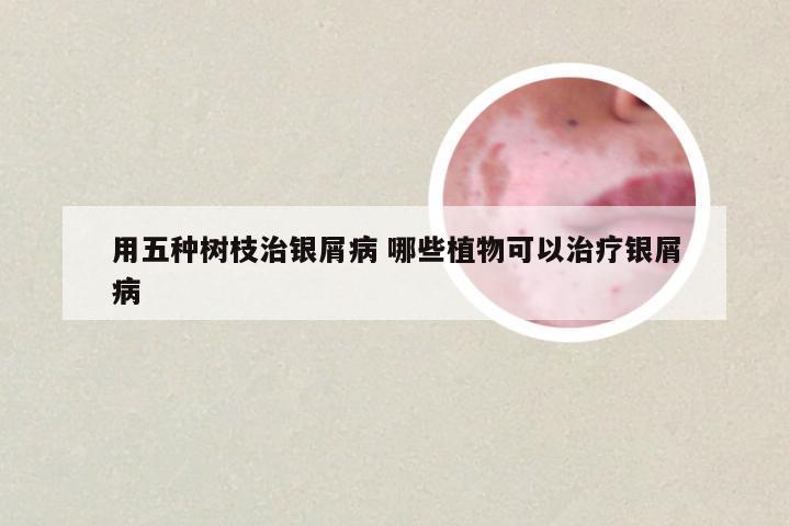 用五种树枝治银屑病 哪些植物可以治疗银屑病