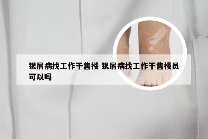 银屑病找工作干售楼 银屑病找工作干售楼员可以吗