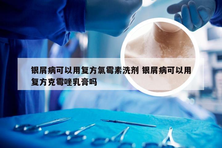银屑病可以用复方氯霉素洗剂 银屑病可以用复方克霉唑乳膏吗