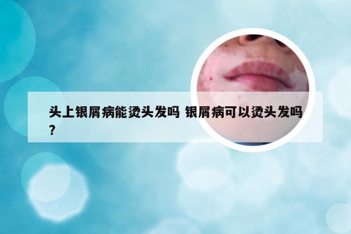 头上银屑病能烫头发吗 银屑病可以烫头发吗?