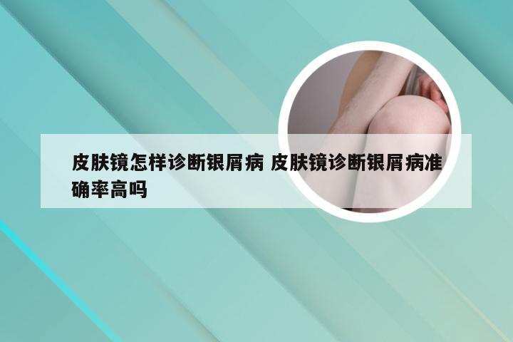 皮肤镜怎样诊断银屑病 皮肤镜诊断银屑病准确率高吗