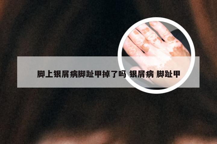 脚上银屑病脚趾甲掉了吗 银屑病 脚趾甲