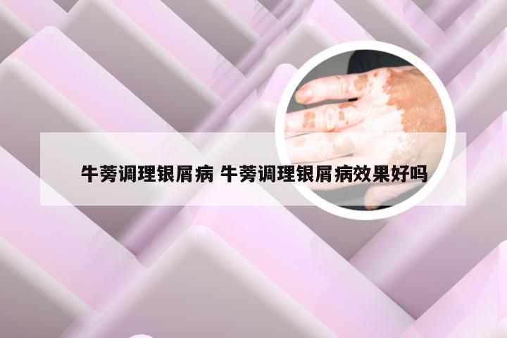 牛蒡调理银屑病 牛蒡调理银屑病效果好吗