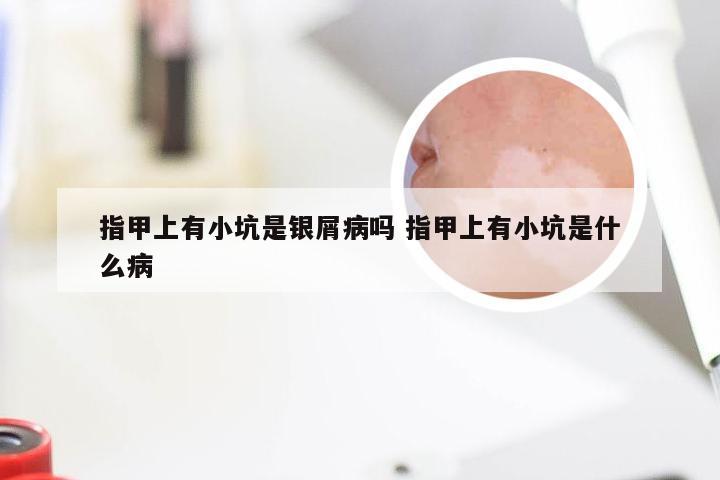 指甲上有小坑是银屑病吗 指甲上有小坑是什么病