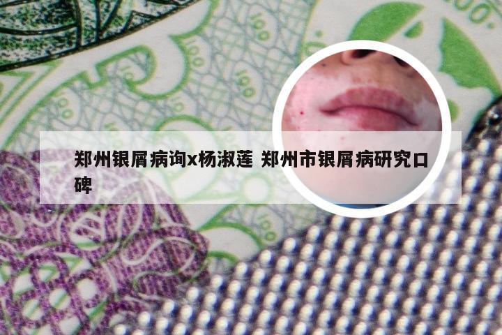 郑州银屑病询x杨淑莲 郑州市银屑病研究口碑