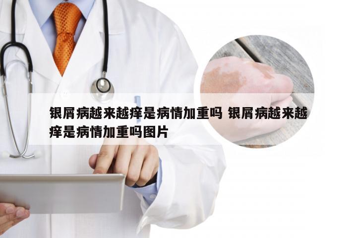 银屑病越来越痒是病情加重吗 银屑病越来越痒是病情加重吗图片
