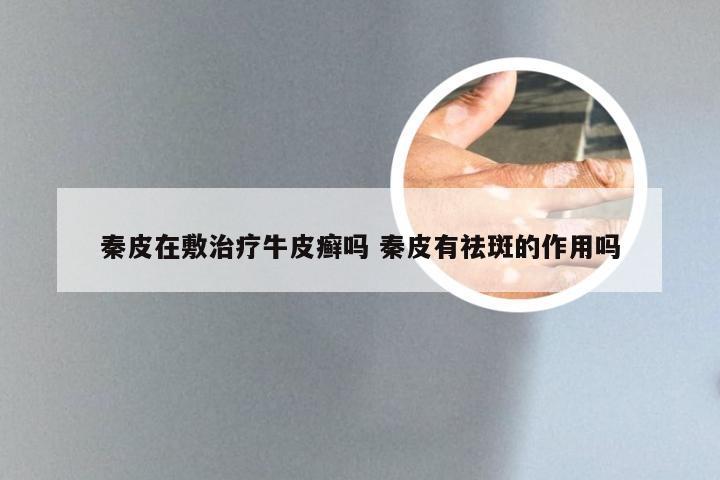 秦皮在敷治疗牛皮癣吗 秦皮有祛斑的作用吗