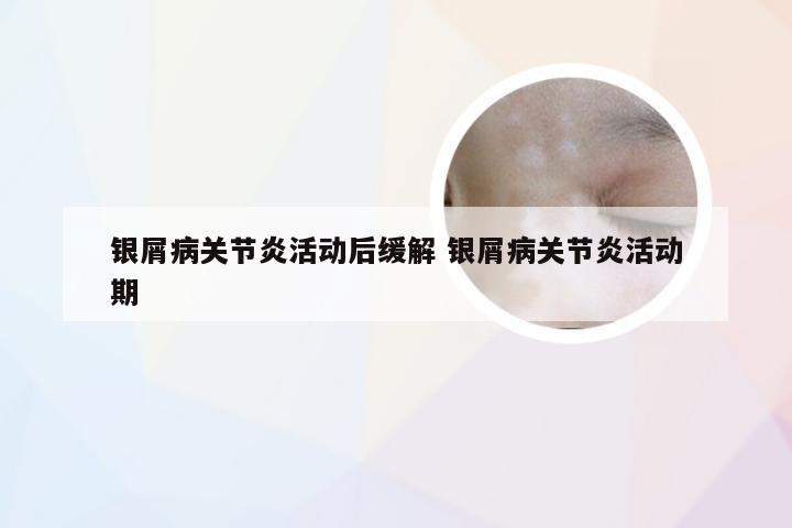 银屑病关节炎活动后缓解 银屑病关节炎活动期