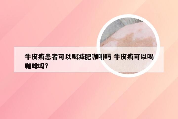 牛皮癣患者可以喝减肥咖啡吗 牛皮癣可以喝咖啡吗?
