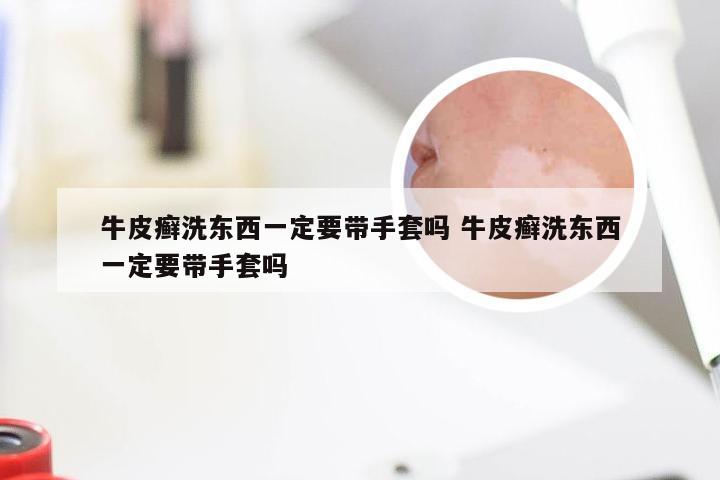 牛皮癣洗东西一定要带手套吗 牛皮癣洗东西一定要带手套吗