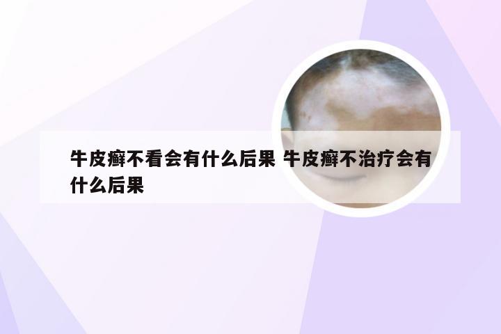 牛皮癣不看会有什么后果 牛皮癣不治疗会有什么后果