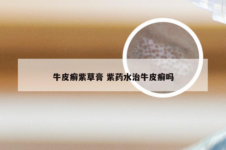牛皮癣紫草膏 紫药水治牛皮癣吗
