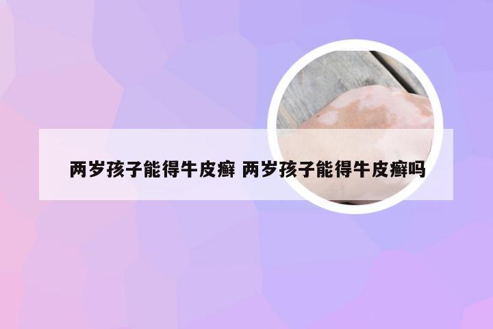 两岁孩子能得牛皮癣 两岁孩子能得牛皮癣吗