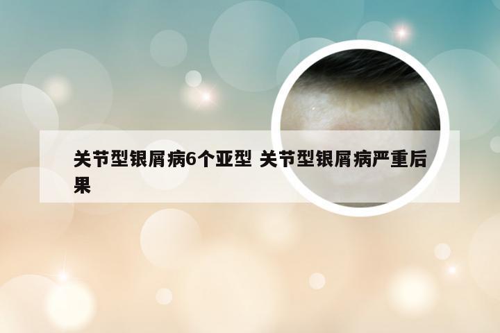关节型银屑病6个亚型 关节型银屑病严重后果