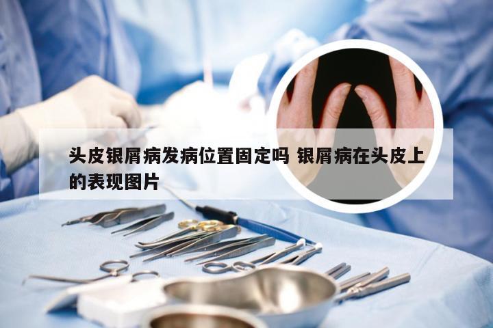 头皮银屑病发病位置固定吗 银屑病在头皮上的表现图片