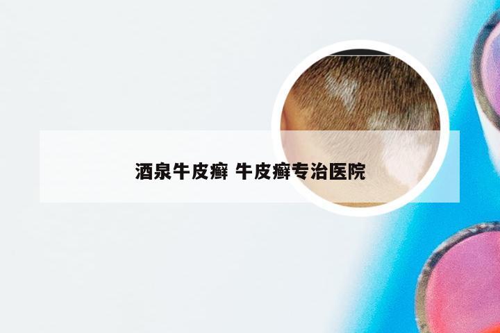 酒泉牛皮癣 牛皮癣专治医院