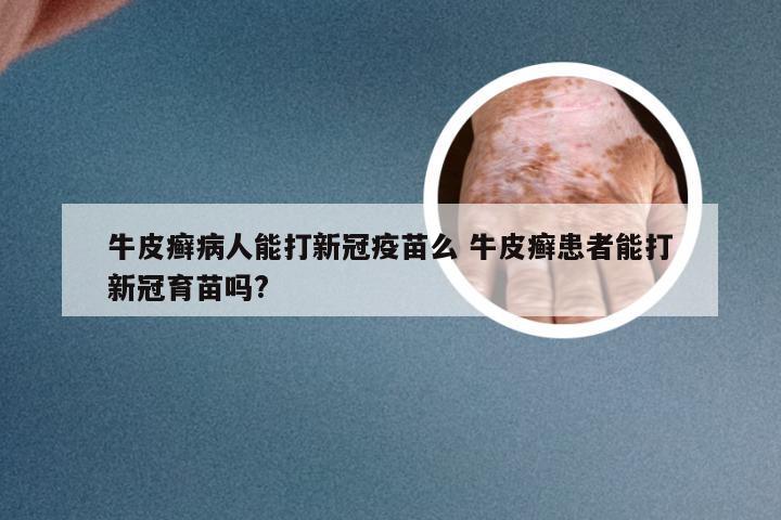 牛皮癣病人能打新冠疫苗么 牛皮癣患者能打新冠育苗吗?