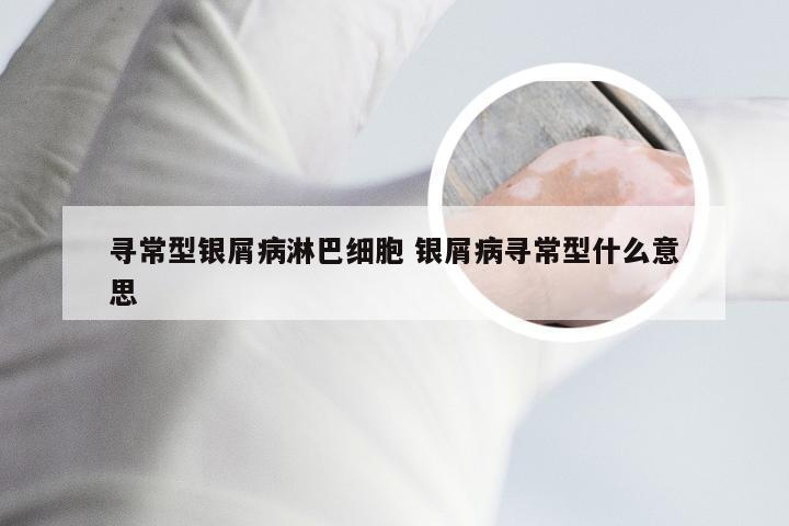 寻常型银屑病淋巴细胞 银屑病寻常型什么意思