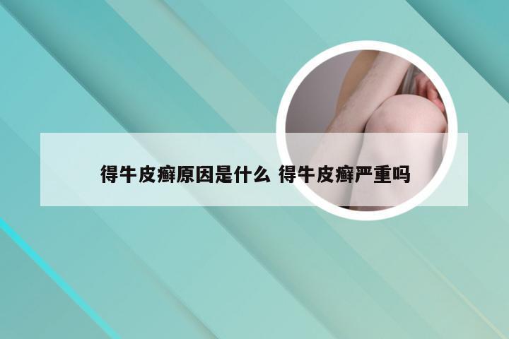 得牛皮癣原因是什么 得牛皮癣严重吗