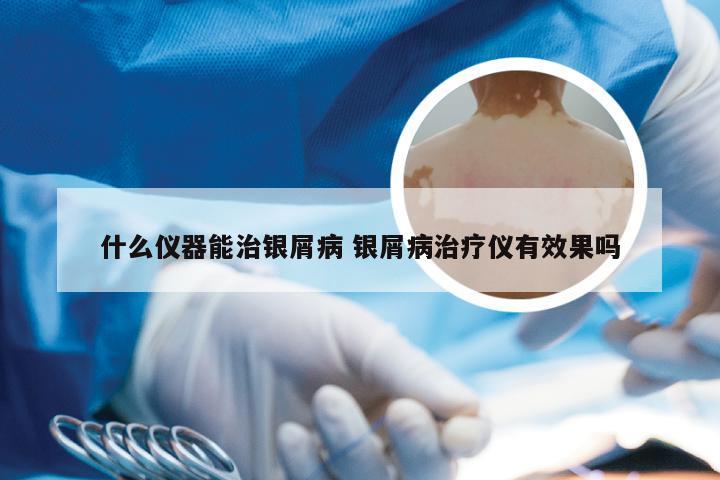 什么仪器能治银屑病 银屑病治疗仪有效果吗