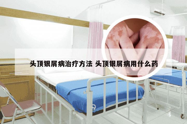 头顶银屑病治疗方法 头顶银屑病用什么药
