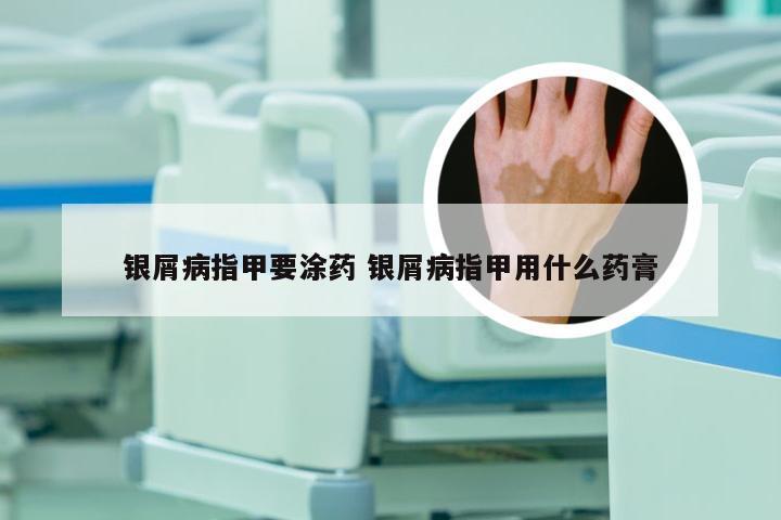 银屑病指甲要涂药 银屑病指甲用什么药膏
