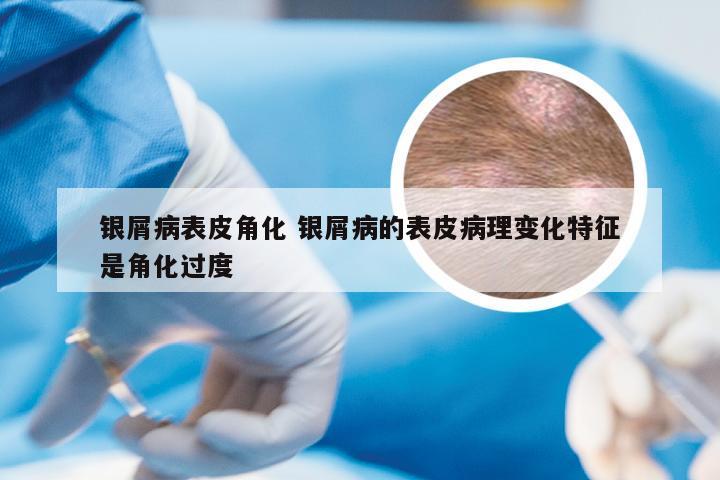 银屑病表皮角化 银屑病的表皮病理变化特征是角化过度