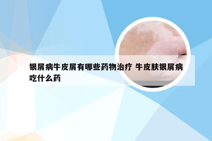 银屑病牛皮屑有哪些药物治疗 牛皮肤银屑病吃什么药