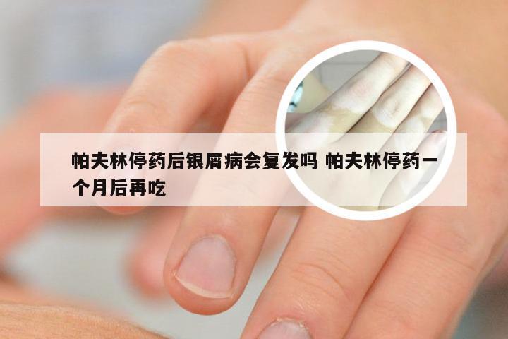 帕夫林停药后银屑病会复发吗 帕夫林停药一个月后再吃