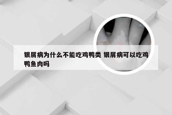 银屑病为什么不能吃鸡鸭类 银屑病可以吃鸡鸭鱼肉吗
