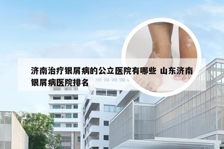 济南治疗银屑病的公立医院有哪些 山东济南银屑病医院排名