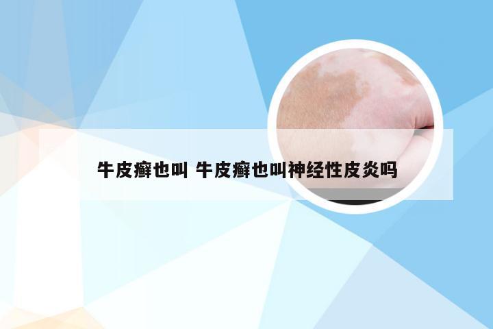 牛皮癣也叫 牛皮癣也叫神经性皮炎吗