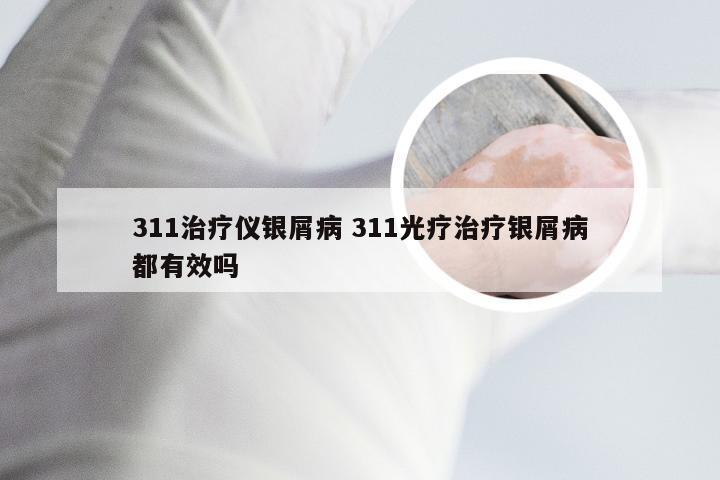 311治疗仪银屑病 311光疗治疗银屑病都有效吗