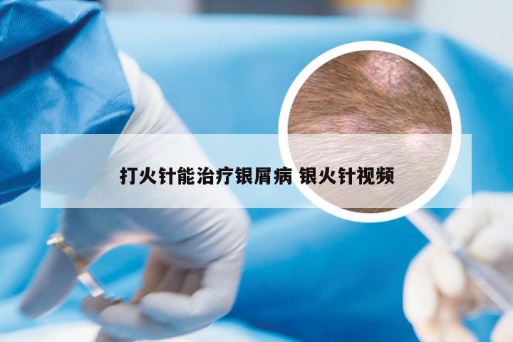 打火针能治疗银屑病 银火针视频