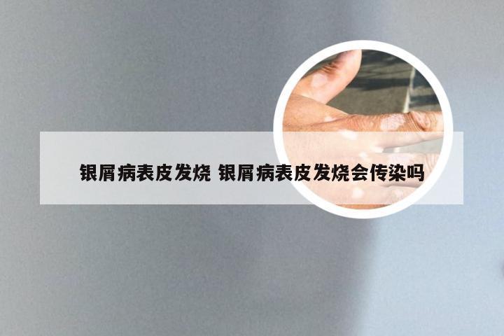 银屑病表皮发烧 银屑病表皮发烧会传染吗