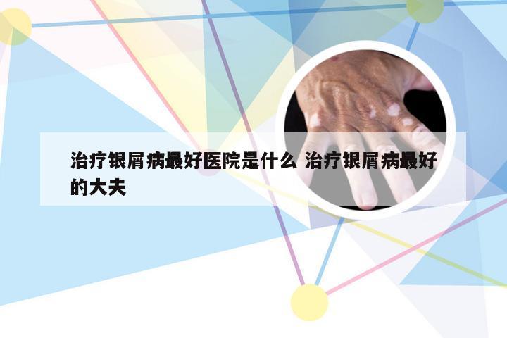 治疗银屑病最好医院是什么 治疗银屑病最好的大夫