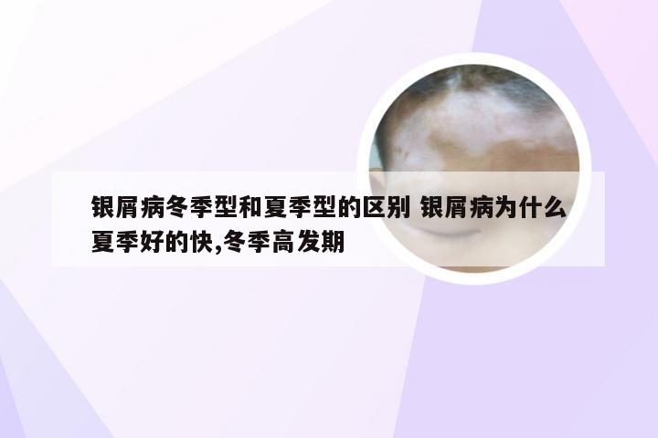 银屑病冬季型和夏季型的区别 银屑病为什么夏季好的快,冬季高发期