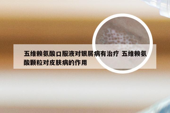五维赖氨酸口服液对银屑病有治疗 五维赖氨酸颗粒对皮肤病的作用