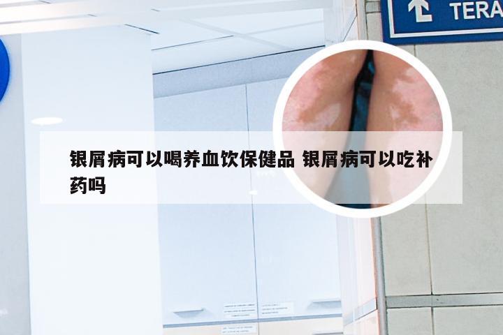 银屑病可以喝养血饮保健品 银屑病可以吃补药吗