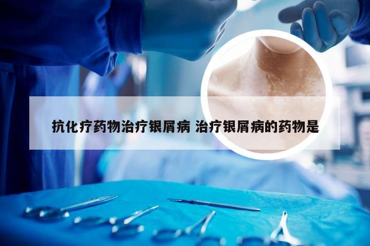 抗化疗药物治疗银屑病 治疗银屑病的药物是